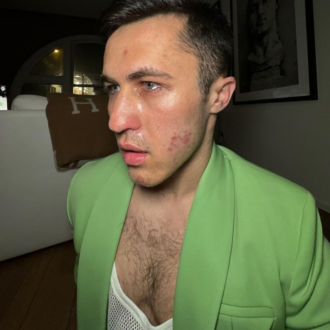 How Chris Olsen Got Ringworm “Down There” and on His Face